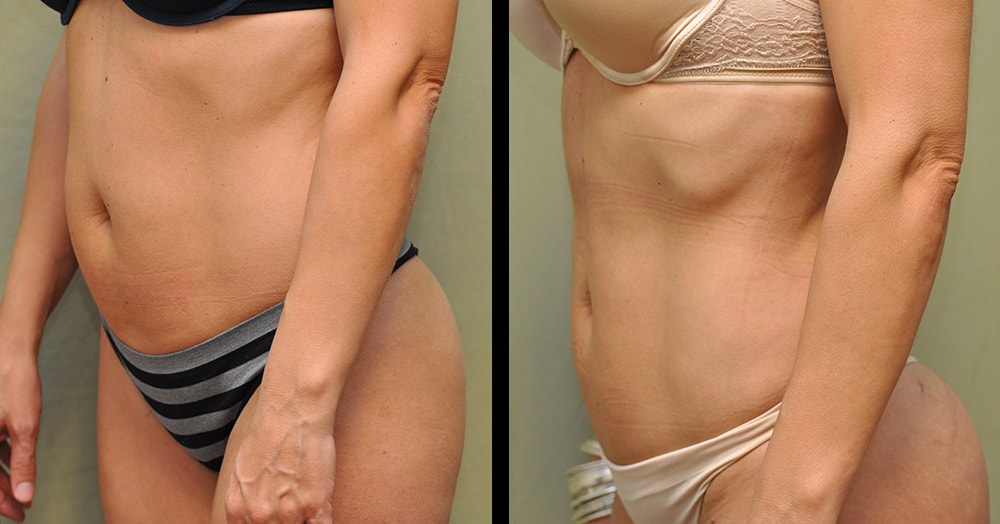 Body abdominal lipo before and after