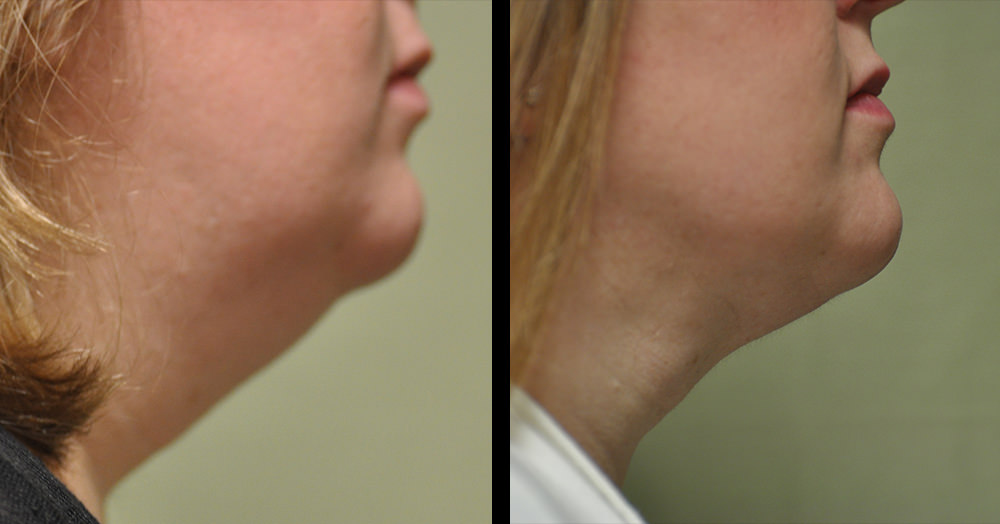 Face and jawline lipo before and after