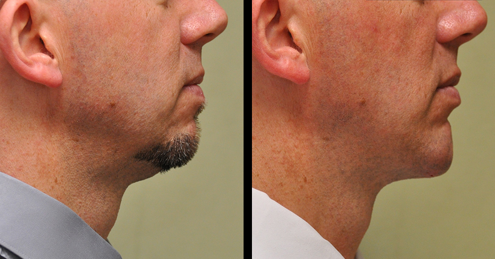 face and neck lipo before and after