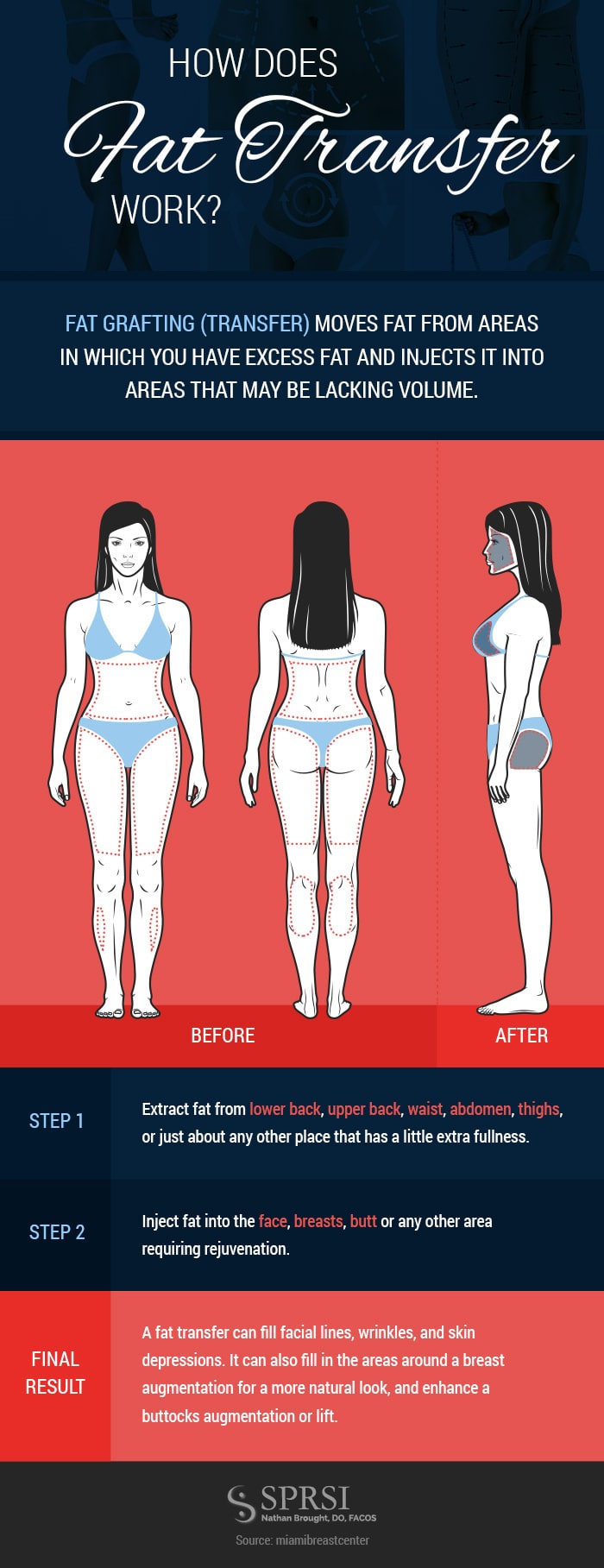 Fat Transfer to Breast Contouring: What to Expect: Advanced Plastic Surgery  Center: Plastic and Reconstructive Surgeons
